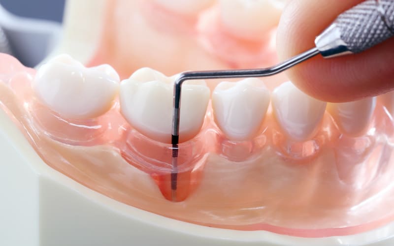 歯周病イメージ