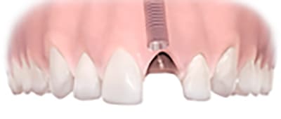 インプラント体挿入