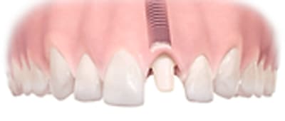 アパットメント装着