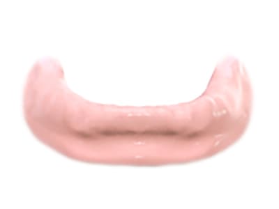 インプラントオーバーデンチャー