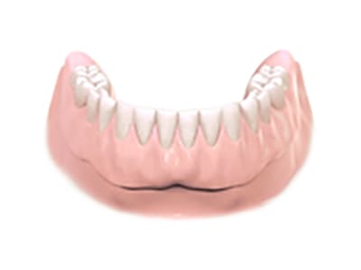 インプラントオーバーデンチャー埋入後