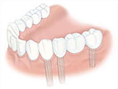 ブリッジ埋入後