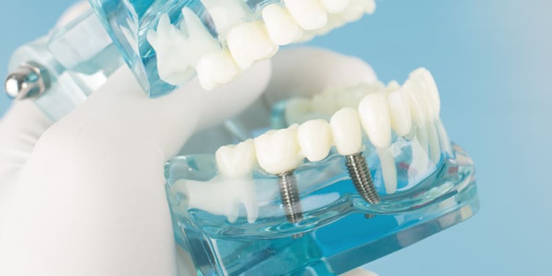 インプラントイメージ