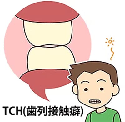TCH(歯列接触癖)イラスト
