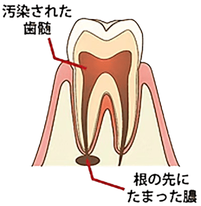 歯内部イラスト