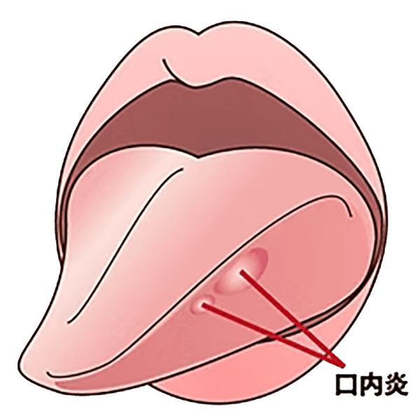 口内炎イラスト