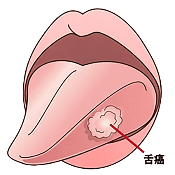 舌癌イラスト