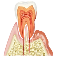 歯肉の炎症及び歯周ポケットの進行